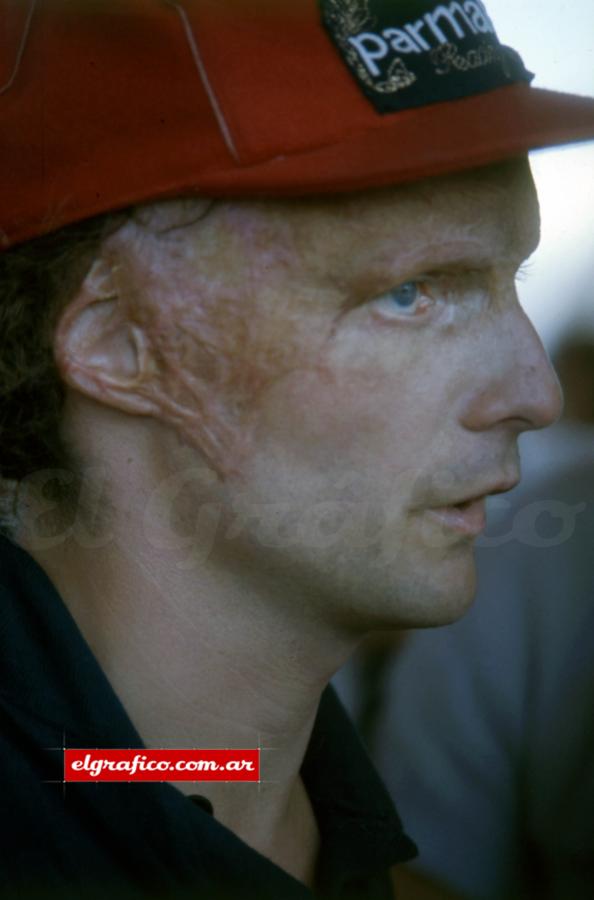 Las secuelas quedaron en el rostro de Lauda, a pesar de eso, siguió corriendo.