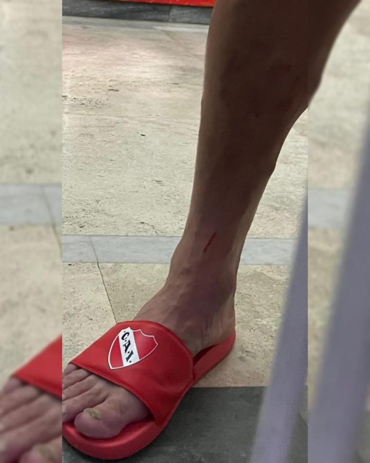Imagen Así le quedó a Marcone su pierna derecha por el planchazo de Domínguez.