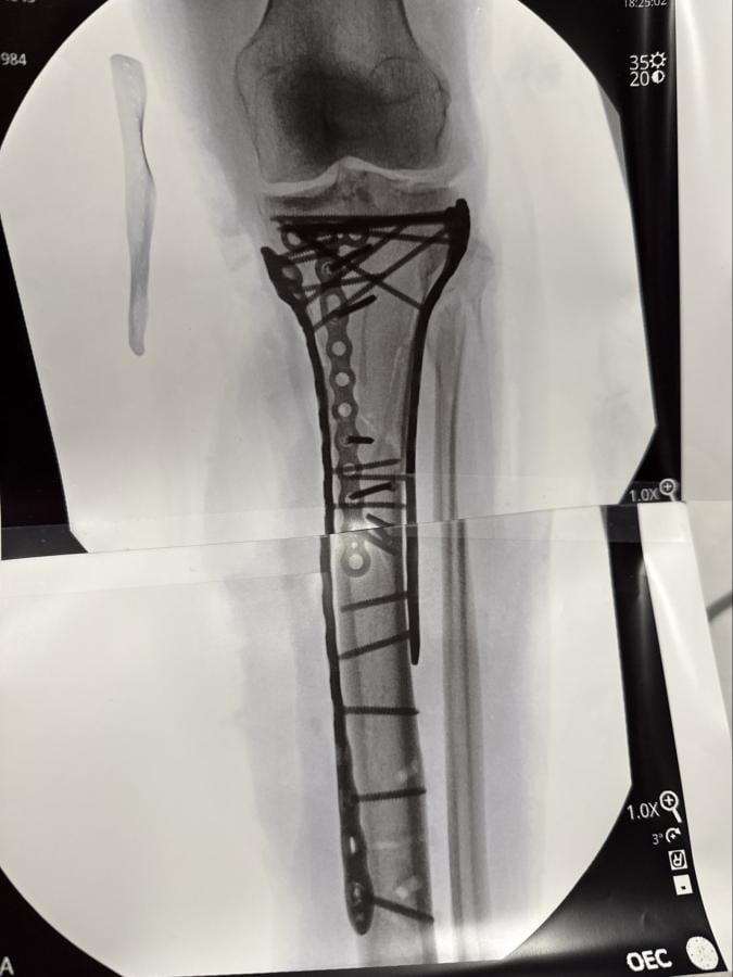 Imagen "Soy biónica", dijo Linsey Vonn al mostrar la radiografía de su pierna destrozada.