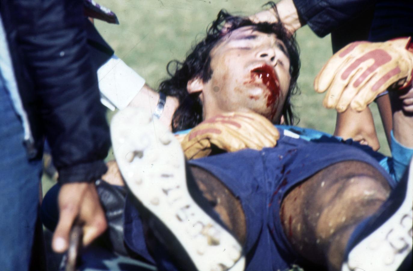 Imagen Abril de 1976: la terrible lesión de mandíbula que sufrió Gatti ante Independiente.