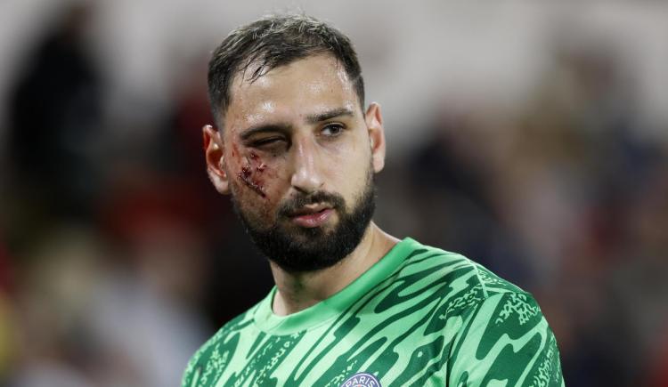Imagen de Impactante: así quedó el rostro de Donnarumma tras un planchazo